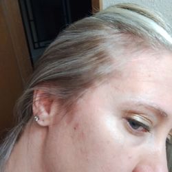 Sunrise Salon - Here is another pic of the other side where she left die all over my scalp and skin.