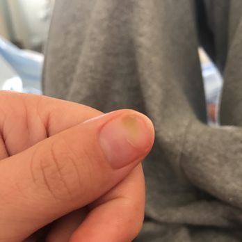 Tracy's Nails - two days after a fill I have to rip my acrylics off because fungus is growing underneath - Nail Salons Near Me - Capitola, California Tracy's Nails - two days after a fill I have to rip my acrylics off because fungus is growing underneath - Nail Salons Near Me - Capitola, California