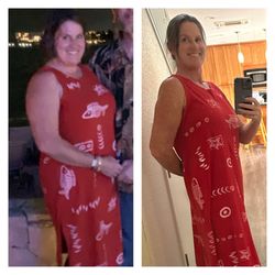 Lite Body Sculpting - Saw that picture today, found that dress, and tried it on... my before and after Chirothin and lite body sculpting...