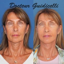 Thomas Guidicelli - Deep plane facelift