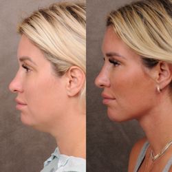 Ben Talei, MD - Weekend Necklift