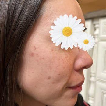 La Bella Laser & Slimming - Day 1: Laser Treatment for hyperpigmentation and age spots. - Medical Spas Near Me - Arcadia, California