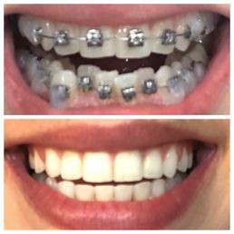 Before and after Before and after