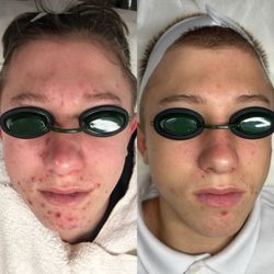 Face Five Acne Clinic