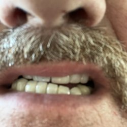 Seascape Cosmetic and Implant Dentistry - This is how he fix my lower canine 22 , shorter than my original one. Bad dentist bad person