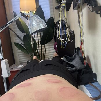 Natural Acupuncture & Cupping Center - Results of cupping - Traditional Chinese Medicine Near Me - Arcadia, California Natural Acupuncture & Cupping Center - Results of cupping - Traditional Chinese Medicine Near Me - Arcadia, California