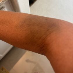 Quest Diagnostics - This is how the Phelebotomist named Laura or Lauren did to me 3 days ago at Quest on Beach and Yorktown.