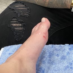 My bleeding foot