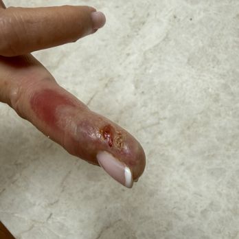 Princeton Nails - Infected finger - Nail Salons Near Me - Princeton, New Jersey Princeton Nails - Infected finger - Nail Salons Near Me - Princeton, New Jersey