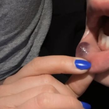 Eye Candy Medspa - Bloody lip filler - Medical Spas Near Me - Las Vegas, Nevada Eye Candy Medspa - Bloody lip filler - Medical Spas Near Me - Las Vegas, Nevada