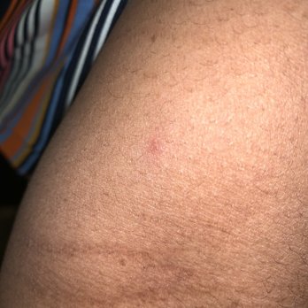 Hampton Inn Raleigh/Clayton I-40 - Bug bite - Hotels Near Me - Garner, North Carolina Hampton Inn Raleigh/Clayton I-40 - Bug bite - Hotels Near Me - Garner, North Carolina