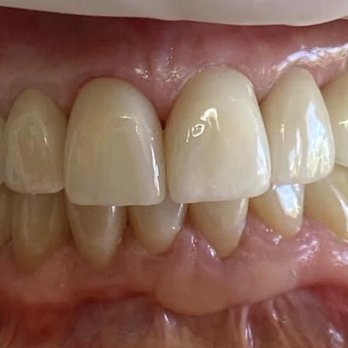 Wendy C. Lu, DDS - Cosmetic enhancement needs healthy gums as backdrop. - General Dentistry Near Me - Cupertino. Can, California Wendy C. Lu, DDS - Cosmetic enhancement needs healthy gums as backdrop. - General Dentistry Near Me - Cupertino. Can, California