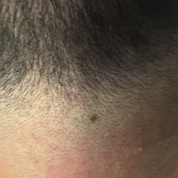 4Ever Faded Barber Shop - Close to the skin rash so you can see how gross it is - Barbers Near Me - Eureka, California