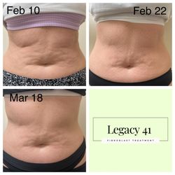 Legacy 41 - Fibroblast skin tightening for the stomach. great results will be improved with one to two more treatments.