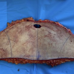 Advanced Surgical Institute - RC Tummy Tuck skin and fat removal