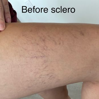 Fitzgibbons Vein Center - Before sclerotherapy of spider veins - Vascular Medicine Near Me - Los Angeles, California Fitzgibbons Vein Center - Before sclerotherapy of spider veins - Vascular Medicine Near Me - Los Angeles, California