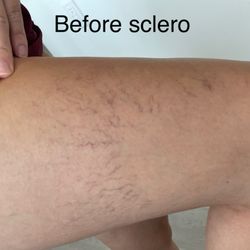 Fitzgibbons Vein Center - Before sclerotherapy of spider veins