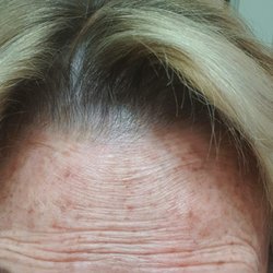 Cave Christopher MD - Forehead botox