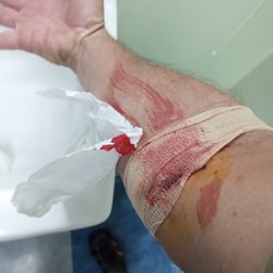 Yes, this doe hurt, it does happen often; no, they don't care. I had blood all over my clothes. The tech is incompetent, I get deferred.