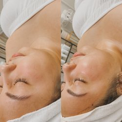 Befor and after of The Classic Facial