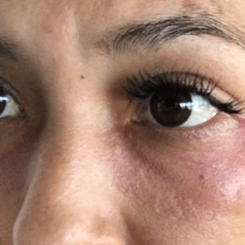 Amazing Lash Studio - DAY 5: Still healing from the reaction. The swelling has gone down, but the rash and redness remains. - Eyelash Service Near Me - Chandler, Arizona