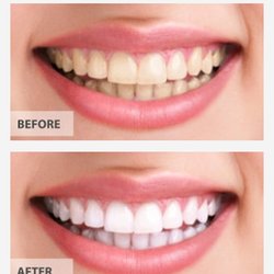 Zoom teeth whitening