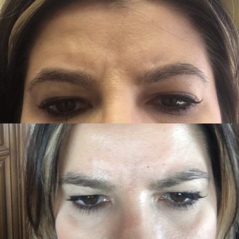 Skinjectables Anti Aging Bar - The after is only within an hour...... I love it! Botox injection - Medical Spas Near Me - Tucson, Arizona Skinjectables Anti Aging Bar - The after is only within an hour...... I love it! Botox injection - Medical Spas Near Me - Tucson, Arizona