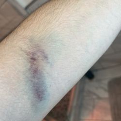 BioLife Plasma Services - The day after my hematoma.