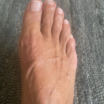 Precision Foot and Ankle Centers - Right foot eight months after surgery. - Podiatrists Near Me - Torrance, California Precision Foot and Ankle Centers - Right foot eight months after surgery. - Podiatrists Near Me - Torrance, California
