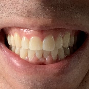 Blue Sky Dental Care - Smiles and Clean Teeth are Always in Fashion at Blue Sky Dental. - General Dentistry Near Me - Bel Air, Maryland Blue Sky Dental Care - Smiles and Clean Teeth are Always in Fashion at Blue Sky Dental. - General Dentistry Near Me - Bel Air, Maryland