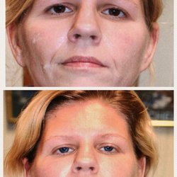 Crystal Lume Medical Spa - This is my before 5 months before any treatments. The second pic was taken yesterday with my blues contacts in. What a difference!