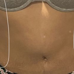 Chicago Breast & Body Aesthetics - One side is more defined.