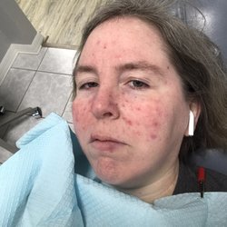 This is my numbed brave face. Also, I'm listening to a hypnosis audio so I'm about to fall asleep. It makes the whole thing go by better.