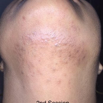 Laser Remedy MedSpa - 2nd Session - Laser Hair Removal Near Me - Philadelphia, Pennsylvania Laser Remedy MedSpa - 2nd Session - Laser Hair Removal Near Me - Philadelphia, Pennsylvania