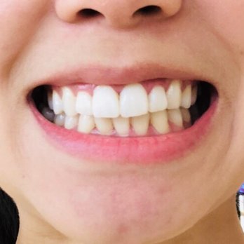 Kevin B. Sands, DDS - Cosmetic Dentistry Beverly Hills - Went in to get started and here I am w temporaries molded in the shape of my teeth for two weeks. Slightly uncomfortable for a few days. - Cosmetic Dentists Near Me - Beverly Hills, California Kevin B. Sands, DDS - Cosmetic Dentistry Beverly Hills - Went in to get started and here I am w temporaries molded in the shape of my teeth for two weeks. Slightly uncomfortable for a few days. - Cosmetic Dentists Near Me - Beverly Hills, California