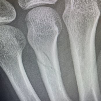 Sun N Sand Motel - "Ring finger" bone in my hand attacked to finger - Hotels Near Me - Kanab, Utah Sun N Sand Motel - "Ring finger" bone in my hand attacked to finger - Hotels Near Me - Kanab, Utah