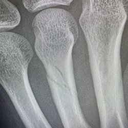 Sun N Sand Motel - "Ring finger" bone in my hand attacked to finger