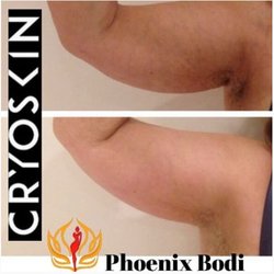 Phoenix Bodi - CyroSkin is a great for sagging under arm skin!