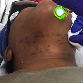 Male Laser Hair Removal Treatment For Ingrown Hairs Treat Areas