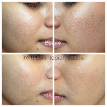 Irene's Skintopia - After one micro-needling session post 4 weeks. - Skin Care Near Me - Los Angeles, California Irene's Skintopia - After one micro-needling session post 4 weeks. - Skin Care Near Me - Los Angeles, California