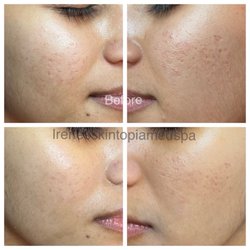 Irene's Skintopia - After one micro-needling session post 4 weeks.
