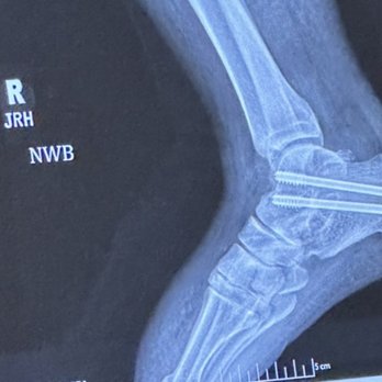 Florida orthopedic Institute - X-ray of the screws that did not fuse. It's called Union. - Sports Medicine Near Me - Brandon, Florida