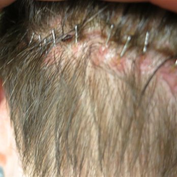 Jae Pak, M.D - 1st FUT Procedure - jagged, uneven donor scar - Hair Loss Centers Near Me - Los Angeles, California