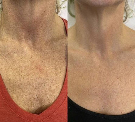 Refine your look with laser treatments - At Refine Med Spa we specialize in treating hyperpigmentation and sun damaged skin. IPL (Intense Pulse Light) is the gold standard in treating hyperpigmentation. It's safe and effective, with very little downtime. We use cutting edge technology to ensure safety and amazing results. Refine your look with laser treatments - At Refine Med Spa we specialize in treating hyperpigmentation and sun damaged skin. IPL (Intense Pulse Light) is the gold standard in treating hyperpigmentation. It's safe and effective, with very little downtime. We use cutting edge technology to ensure safety and amazing results.