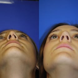FacebyDrH - Rhinoplasty Before and After