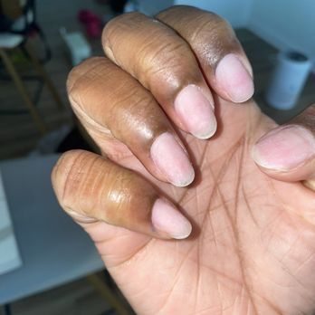 Ana Nails Studio - After removal you can see the polish still on my skin which is itchy. - Nail Technicians Near Me - Farmington Hills, Michigan