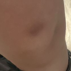 Step By Step Child Development Center - The bruise he got from this school.