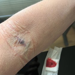 Quest Diagnostics - Blown vein, happened last year too.