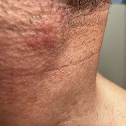 Z-ROC Dermatology