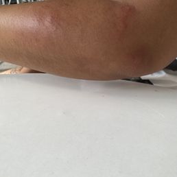 Bites on arm